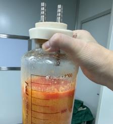 茌平水动力吸脂手术要做多久？